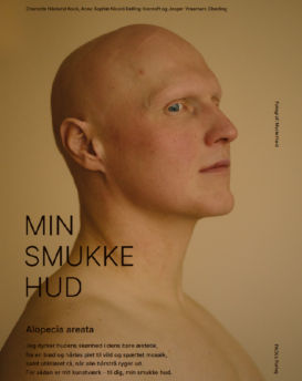 Plakat -  Alopecia areate uden ramme