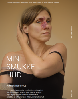 Plakat -  Nævus flammeus med ramme