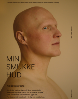 Plakat - Alopecia areata med ramme