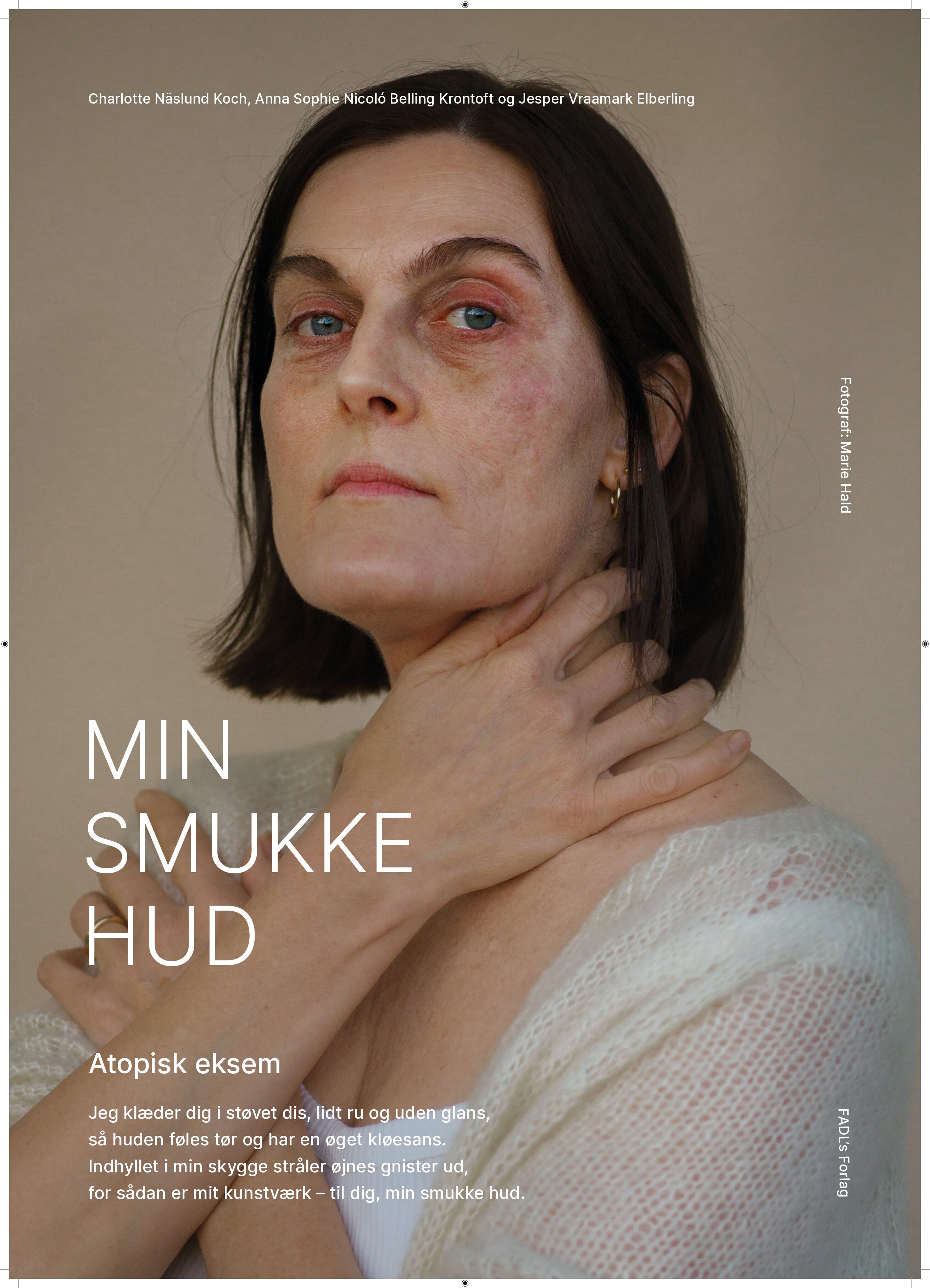 Plakat - Atopisk eksem med ramme