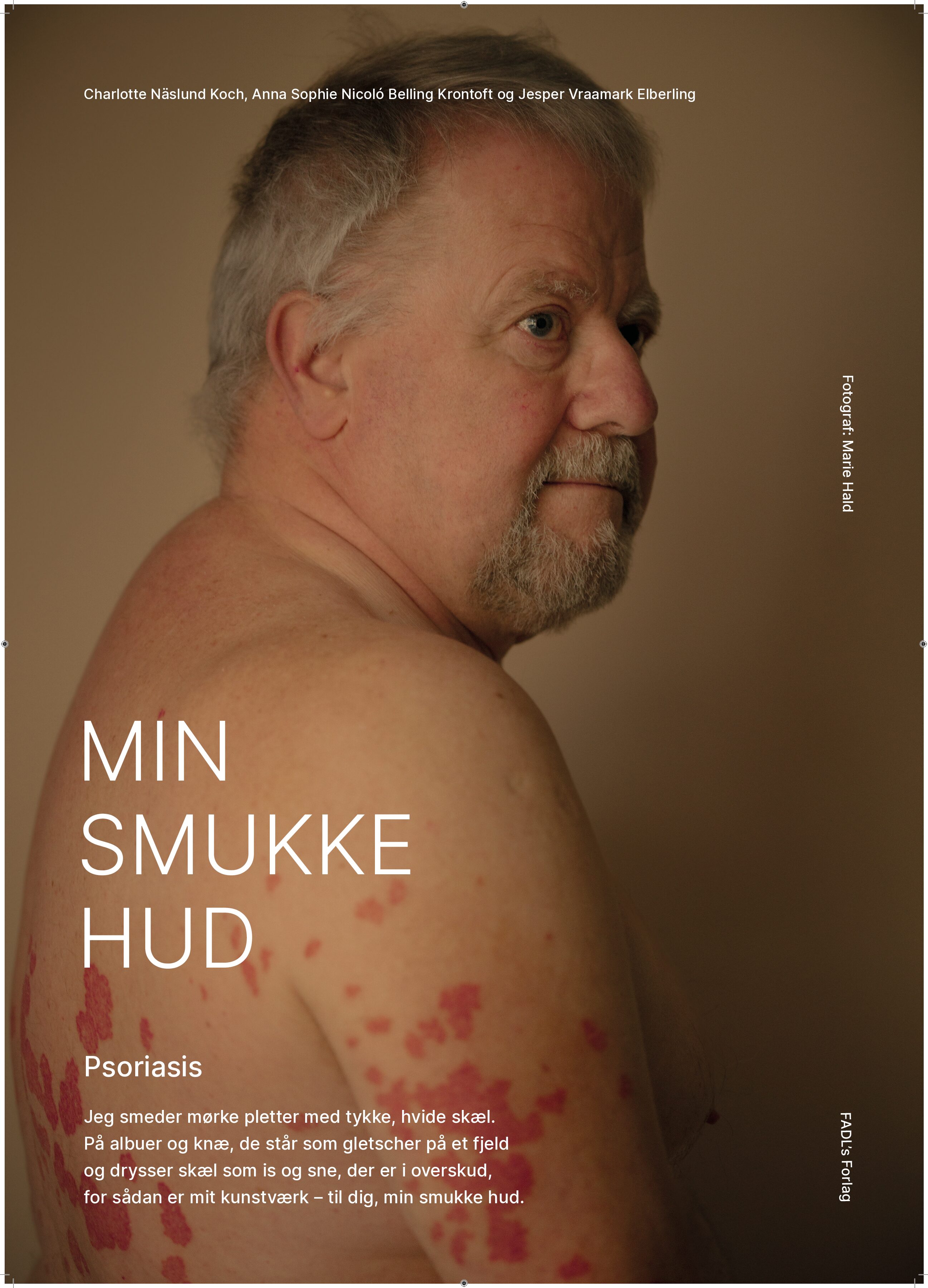 Plakat -  Psoriasis 2 med ramme