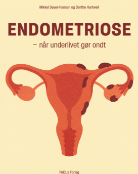 Endometriose - når underlivet gør ondt