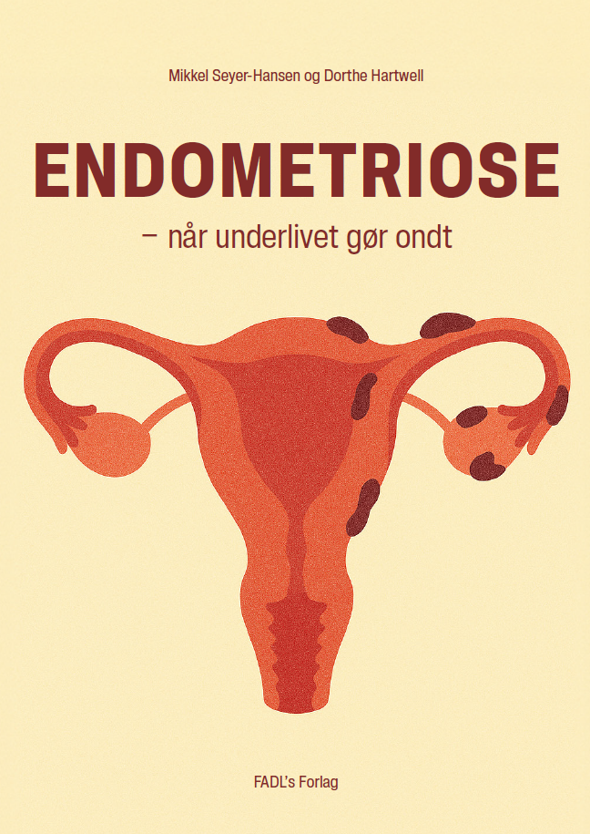 Endometriose - når underlivet gør ondt